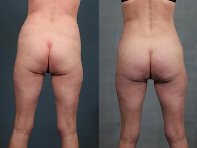 Brazilian Butt Lift Before & After Gallery - Patient 330825 - Image 1