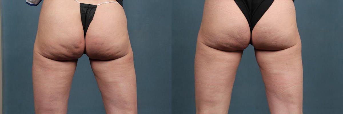 Cellulite Treatments Before & After Gallery - Patient 155666 - Image 1