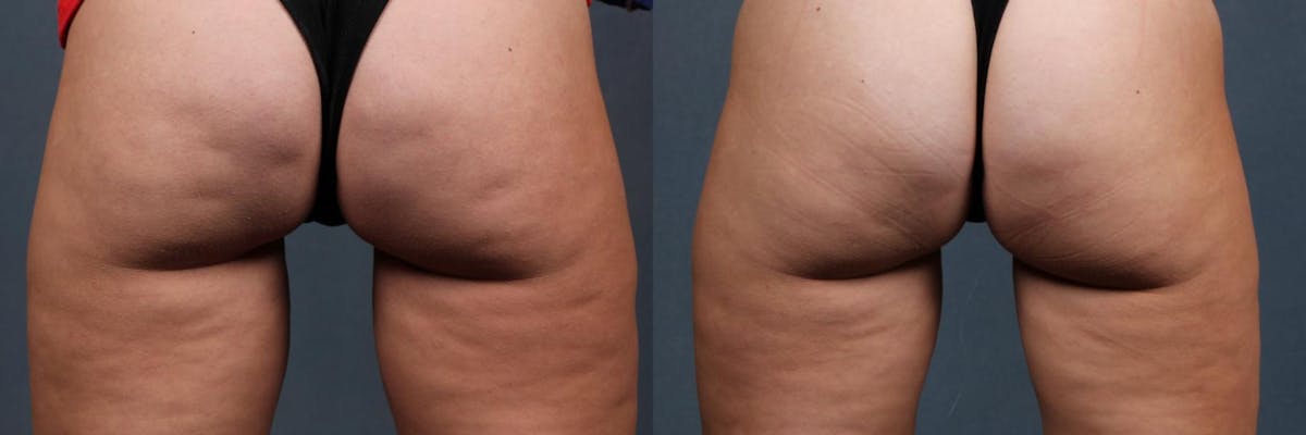 Cellulite Treatments Before & After Gallery - Patient 246720 - Image 1