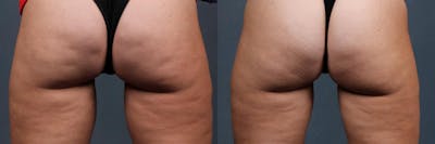 Cellulite Treatments Before & After Gallery - Patient 246720 - Image 1