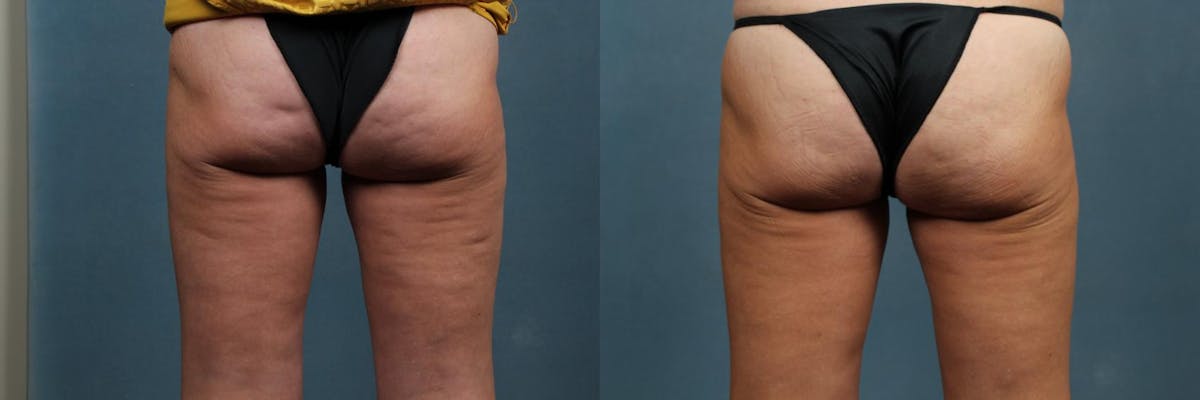 Cellulite Treatments Before & After Gallery - Patient 532273 - Image 1