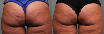 Cellulite Treatments Before & After Gallery - Patient 157271 - Image 1