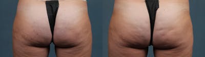 Cellulite Treatments Before & After Gallery - Patient 308590 - Image 1