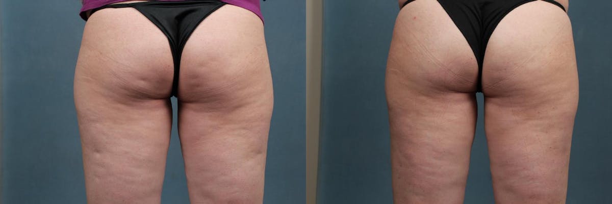 Cellulite Treatments Before & After Gallery - Patient 292648 - Image 1
