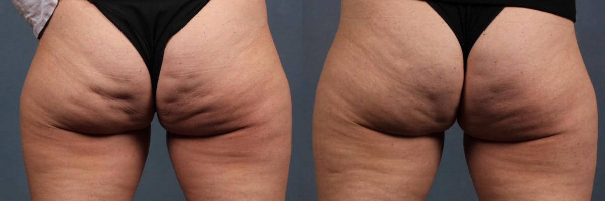 Cellulite Treatments Before & After Gallery - Patient 334633 - Image 1