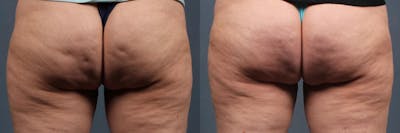 Cellulite Treatments Before & After Gallery - Patient 808041 - Image 1