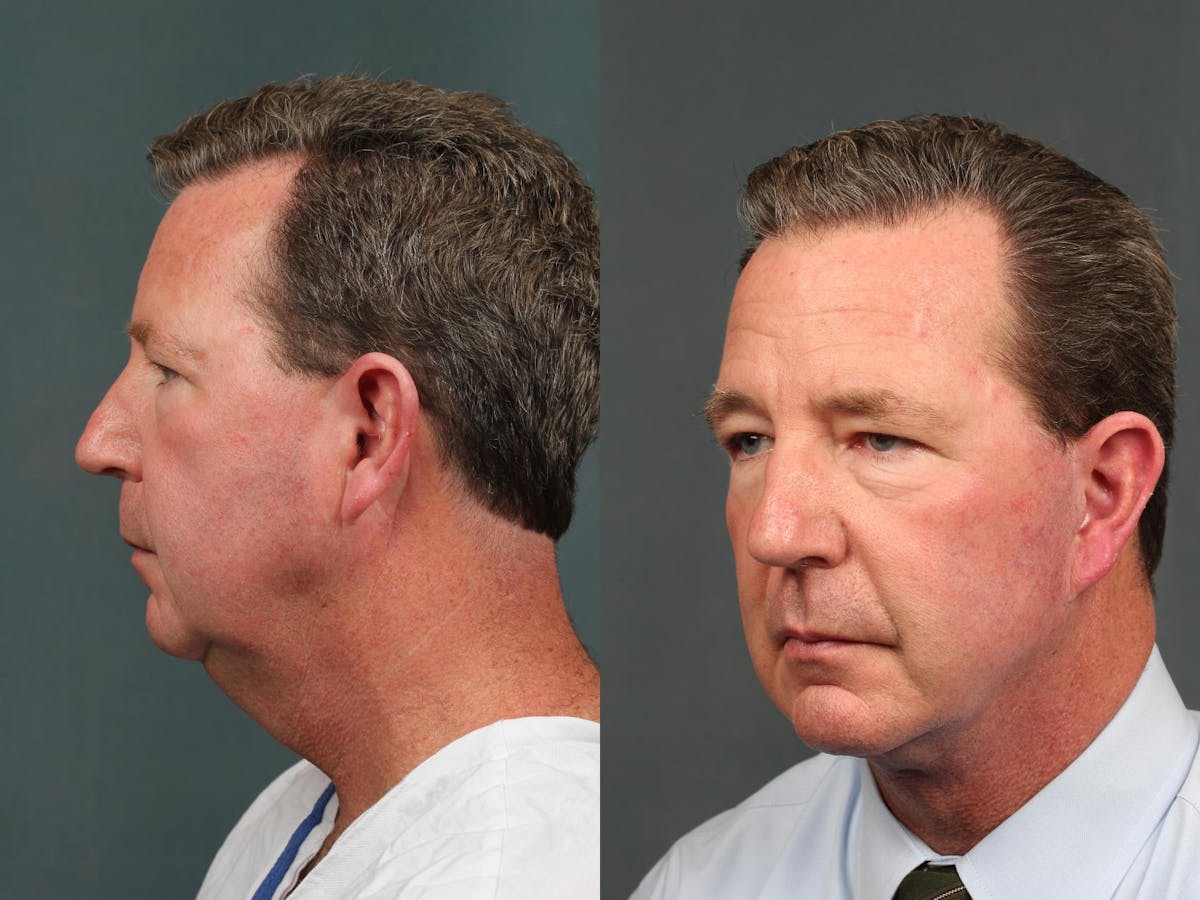 Male Chin Augmentation Before & After Gallery - Patient 365551 - Image 2