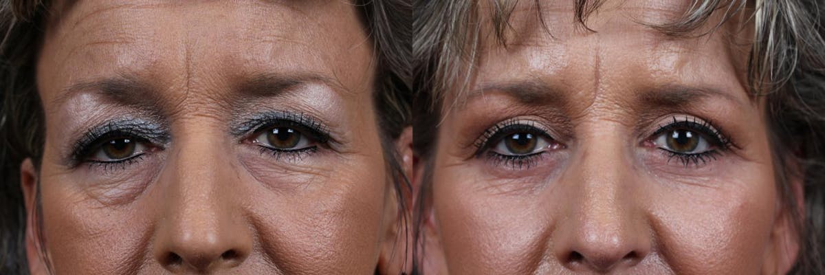 Eyelid Surgery Before & After Gallery - Patient 228530 - Image 1