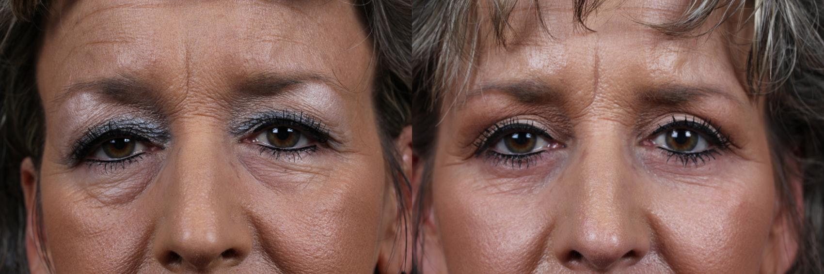 Eyelid Surgery Before & After Gallery - Patient 228530 - Image 1