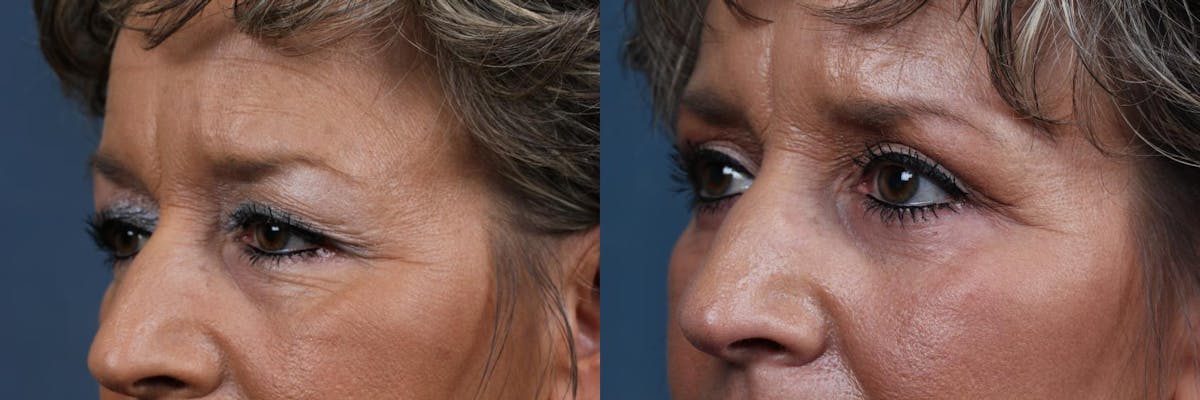 Eyelid Surgery Before & After Gallery - Patient 228530 - Image 3