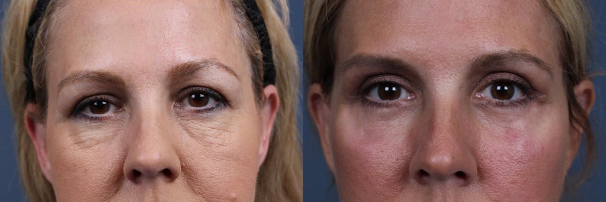 Eyelid Surgery Before & After Gallery - Patient 396015 - Image 1