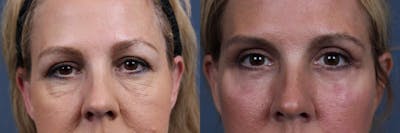 Eyelid Surgery Before & After Gallery - Patient 396015 - Image 1