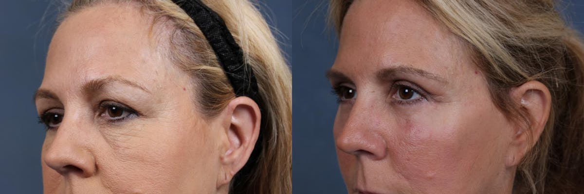 Eyelid Surgery Before & After Gallery - Patient 396015 - Image 2