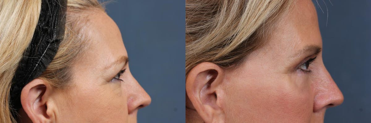 Eyelid Surgery Before & After Gallery - Patient 396015 - Image 3