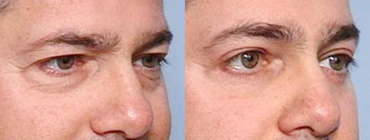 Eyelid Surgery Before & After Gallery - Patient 303635 - Image 2
