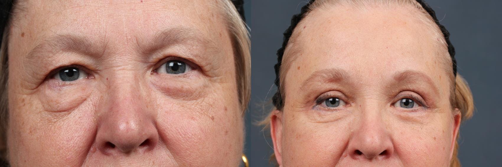 Eyelid Surgery Before & After Gallery - Patient 353589 - Image 1