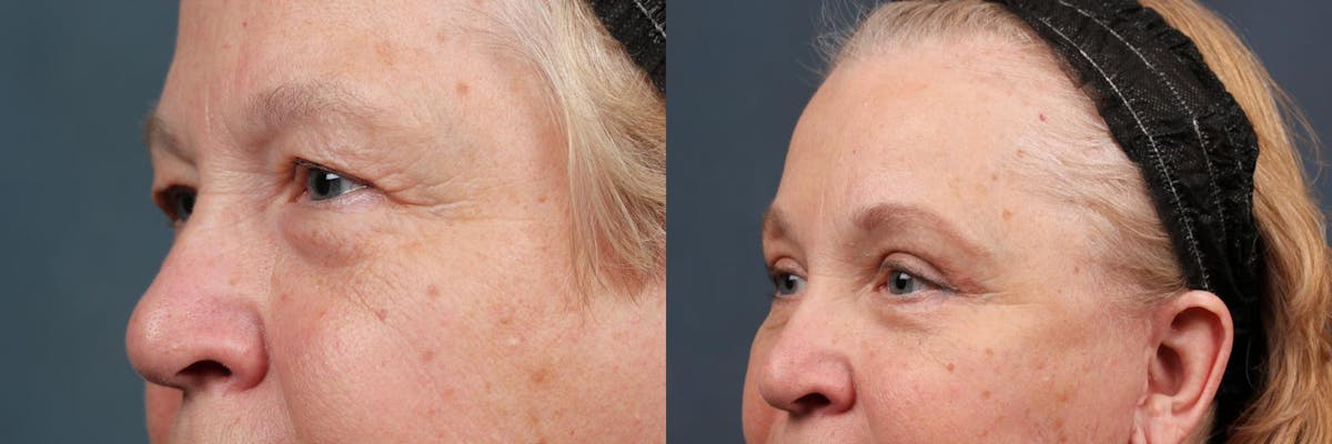 Eyelid Surgery Before & After Gallery - Patient 353589 - Image 2