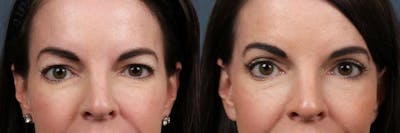 Eyelid Surgery Before & After Gallery - Patient 368360 - Image 1
