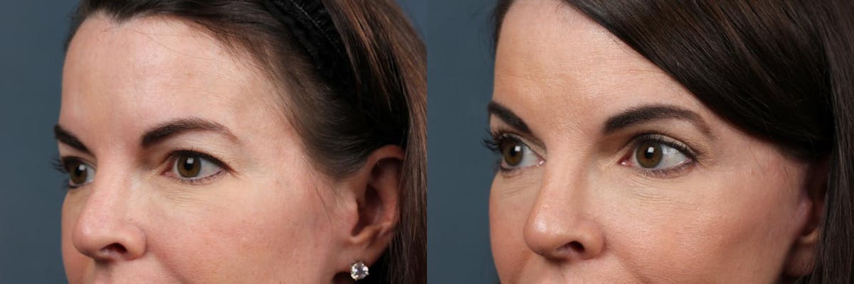 Eyelid Surgery Before & After Gallery - Patient 368360 - Image 2