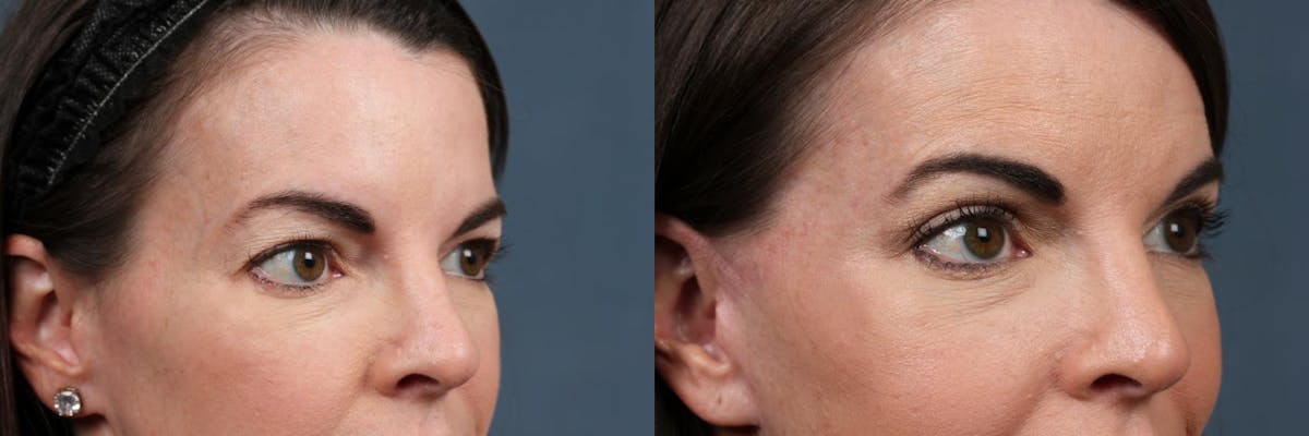 Eyelid Surgery Before & After Gallery - Patient 368360 - Image 3