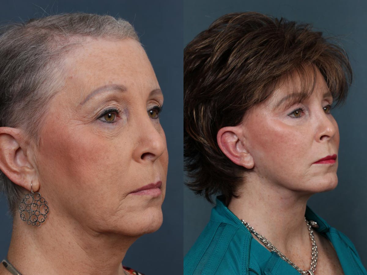 Eyelid Surgery Before & After Gallery - Patient 157634 - Image 2