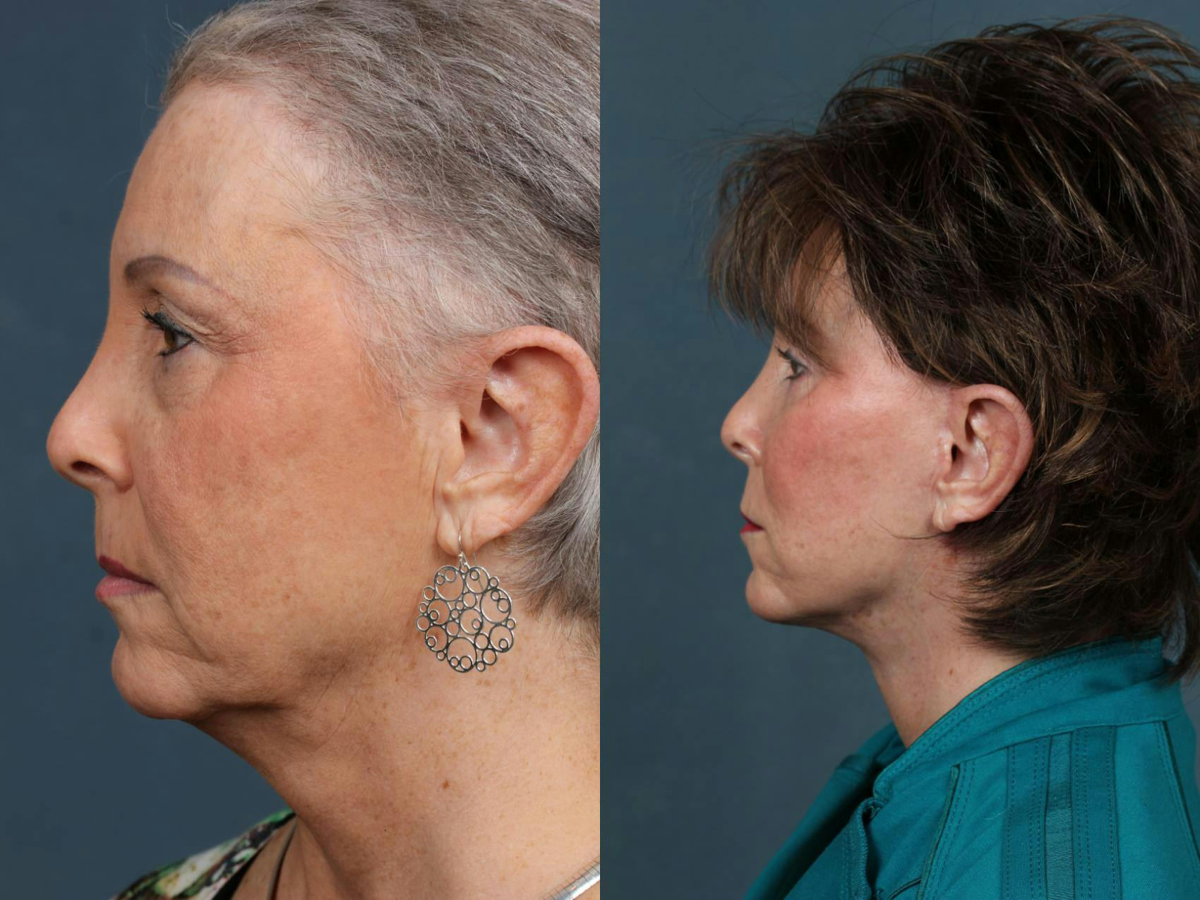 Eyelid Surgery Before & After Gallery - Patient 157634 - Image 3