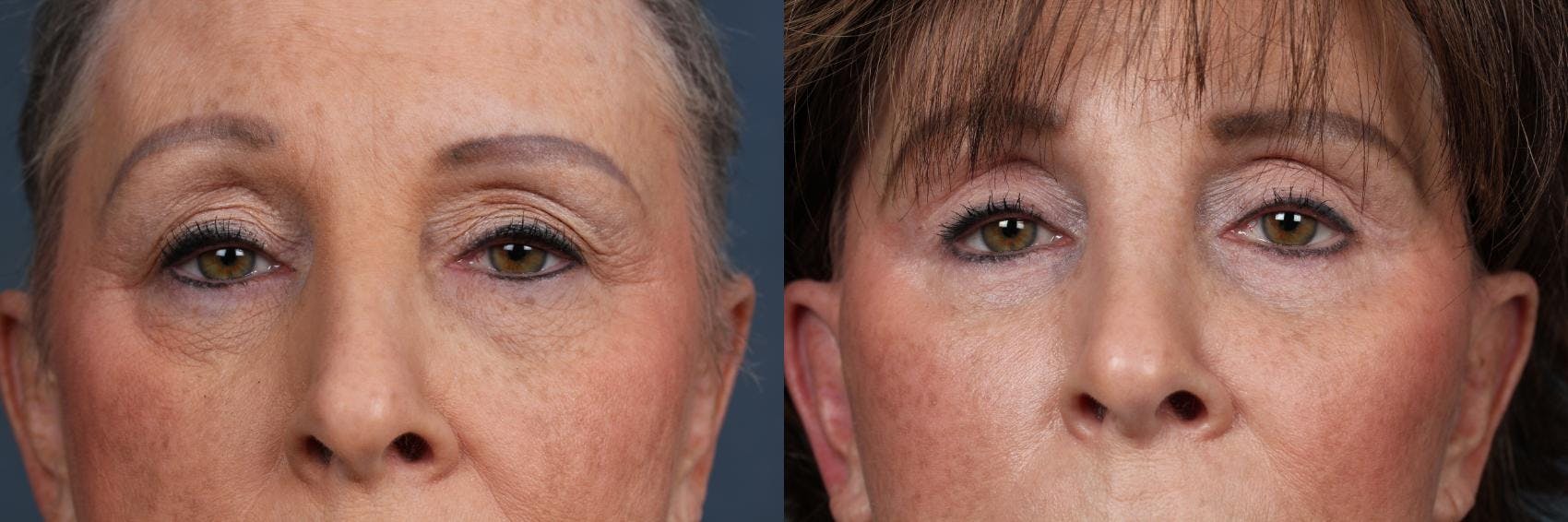 Eyelid Surgery Before & After Gallery - Patient 157634 - Image 4