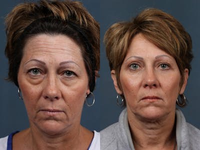 Eyelid Surgery Before & After Gallery - Patient 178498 - Image 1