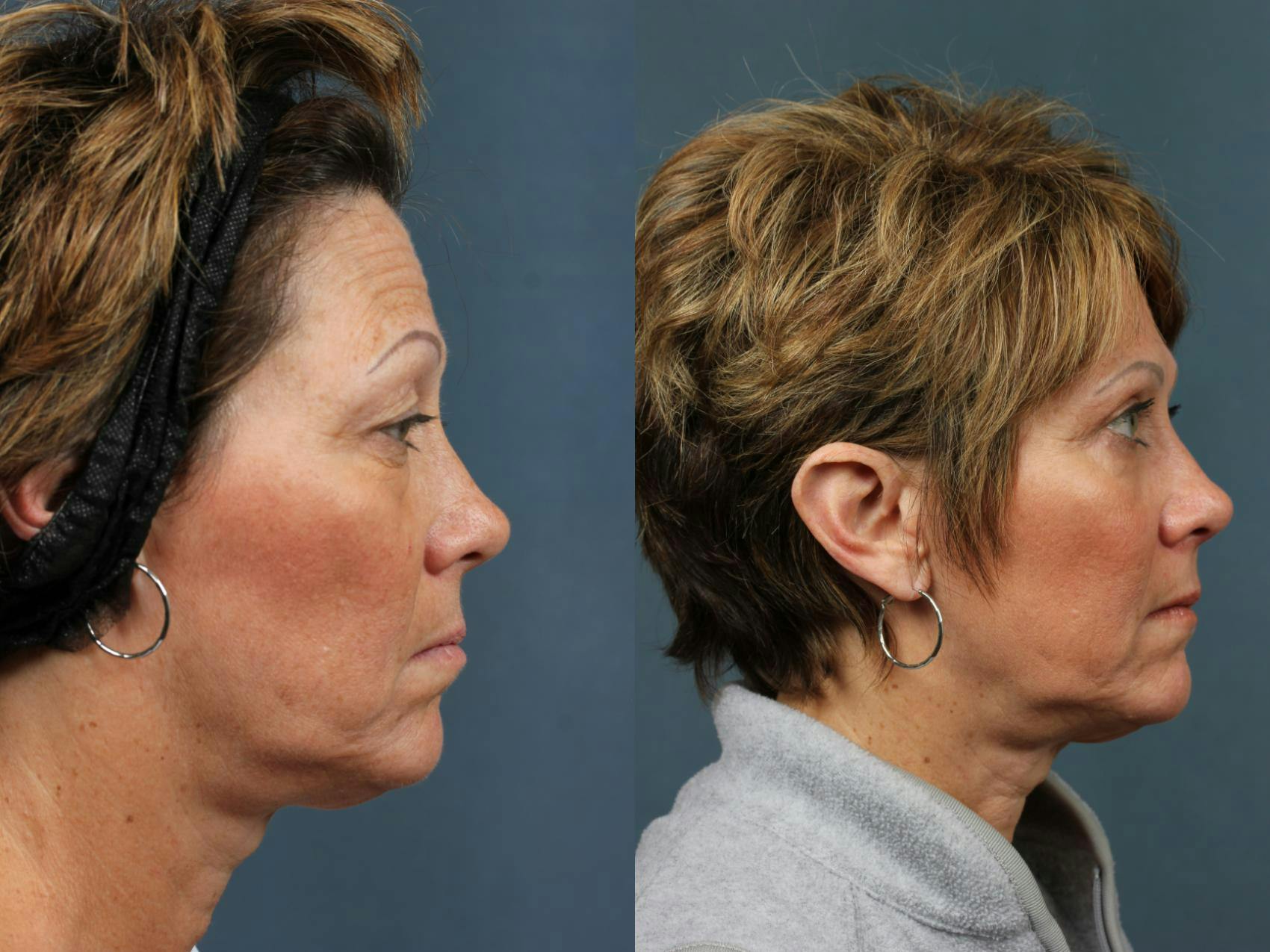 Eyelid Surgery Before & After Gallery - Patient 178498 - Image 3