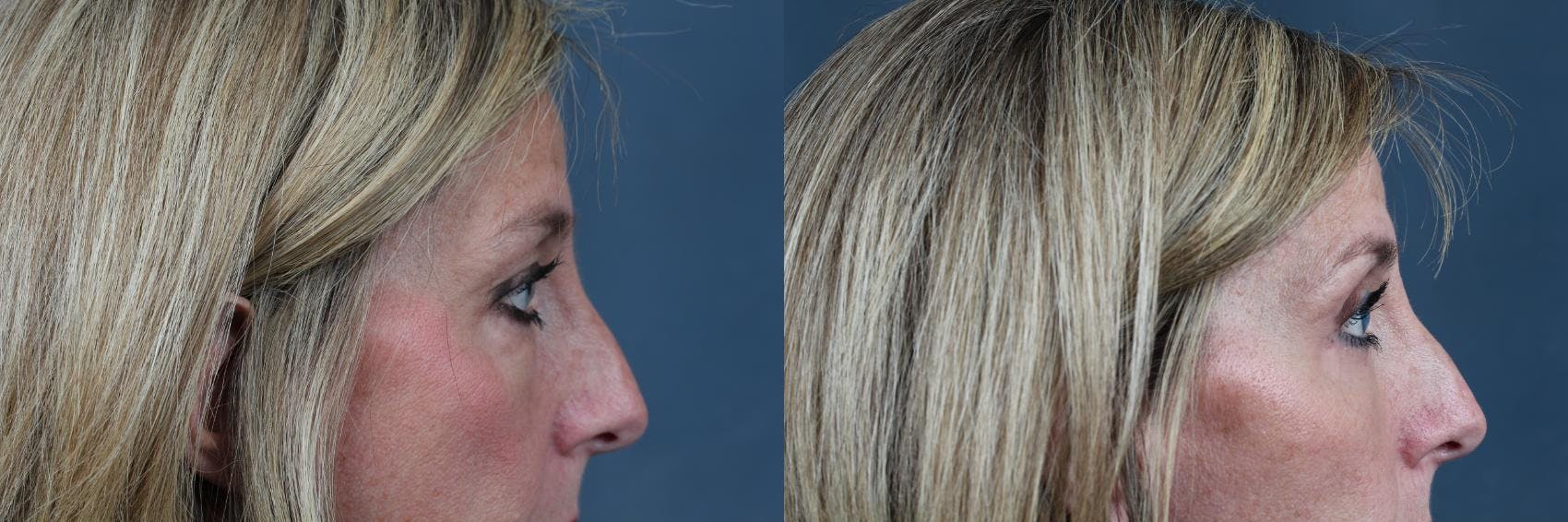 Eyelid Surgery Before & After Gallery - Patient 295352 - Image 2