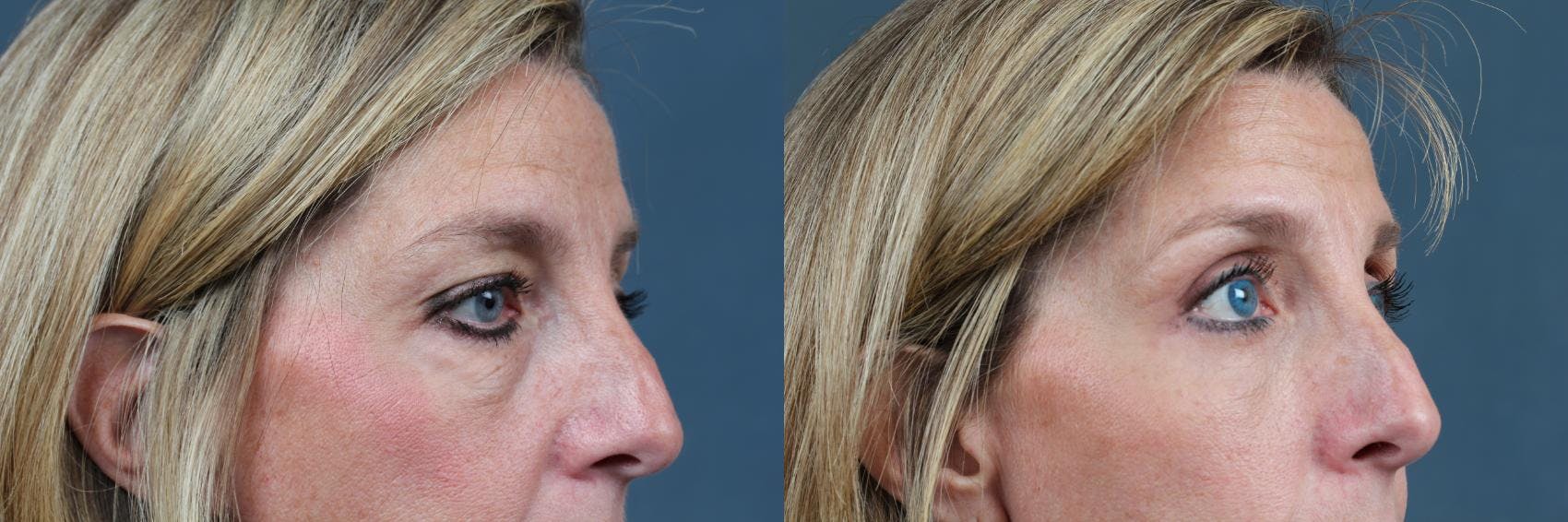 Eyelid Surgery Before & After Gallery - Patient 295352 - Image 3