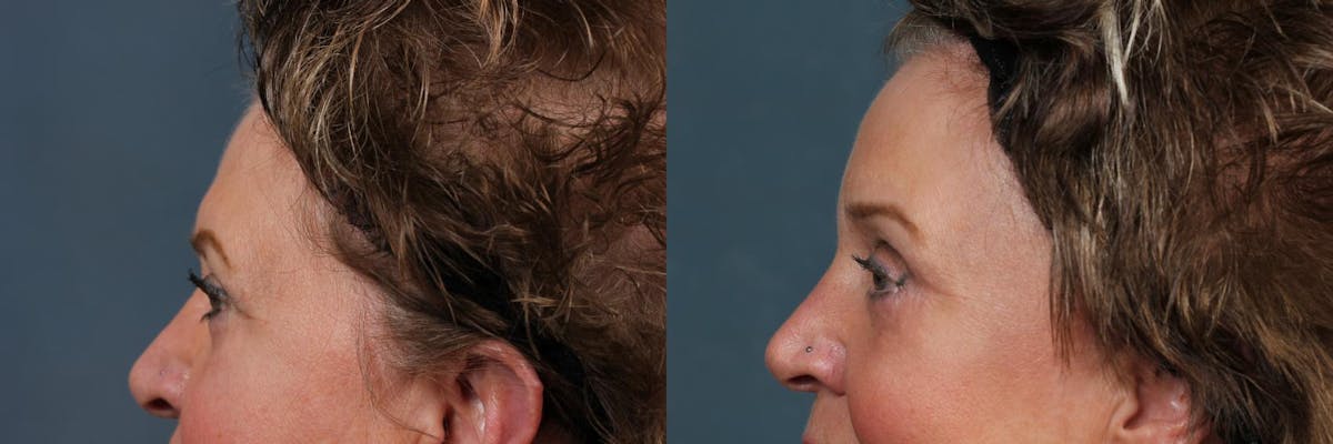 Eyelid Surgery Before & After Gallery - Patient 370654 - Image 2