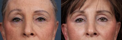 Eyelid Surgery Before & After Gallery - Patient 251285 - Image 1