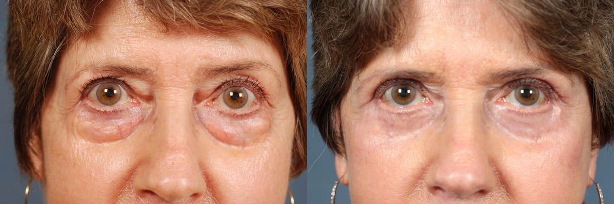 Eyelid Surgery Before & After Gallery - Patient 409632 - Image 1