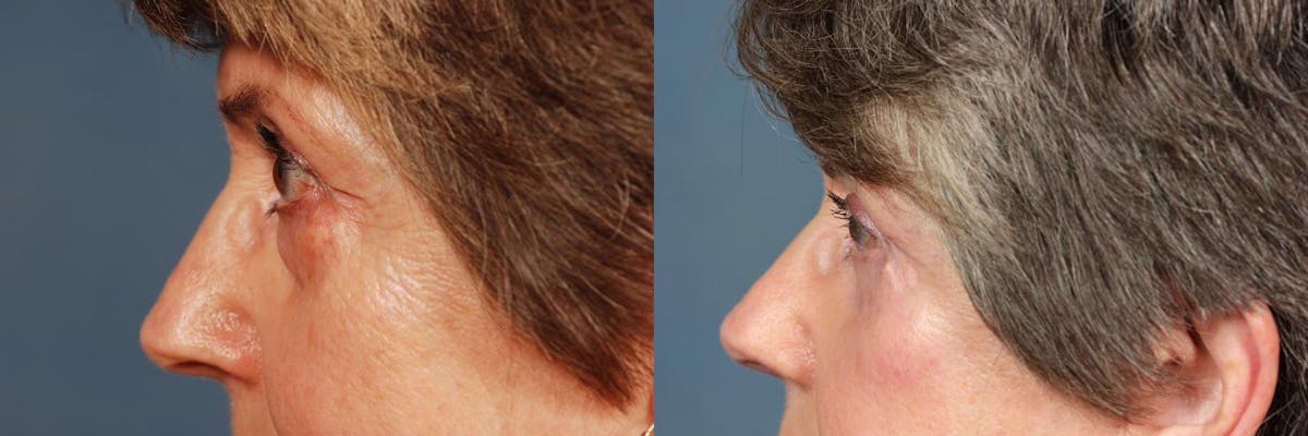 Eyelid Surgery Before & After Gallery - Patient 409632 - Image 3