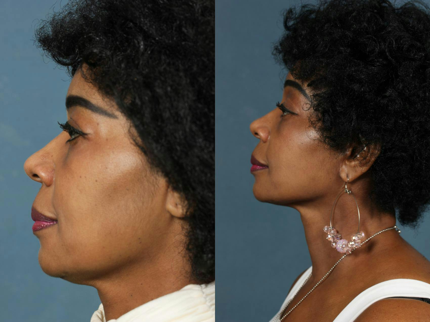 Facelift Before & After Gallery - Patient 271701 - Image 2