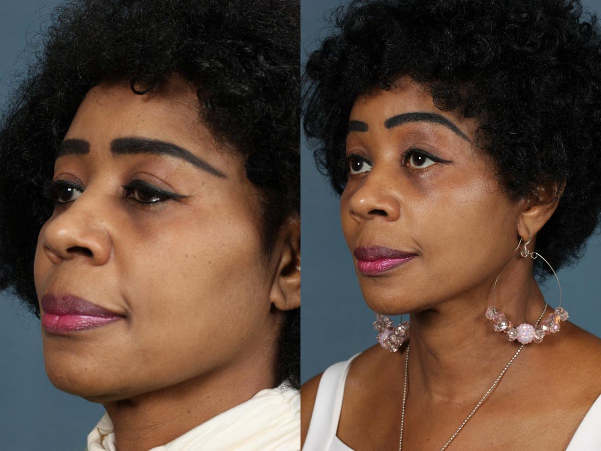 Facelift Before & After Gallery - Patient 271701 - Image 3