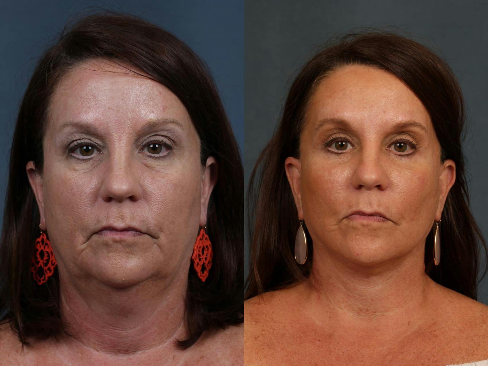 Facelift Before & After Gallery - Patient 853699 - Image 1