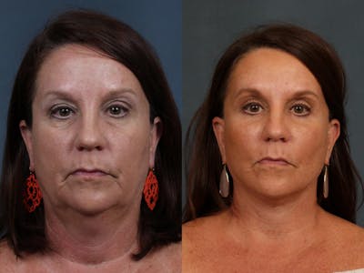 Facelift Before & After Gallery - Patient 853699 - Image 1