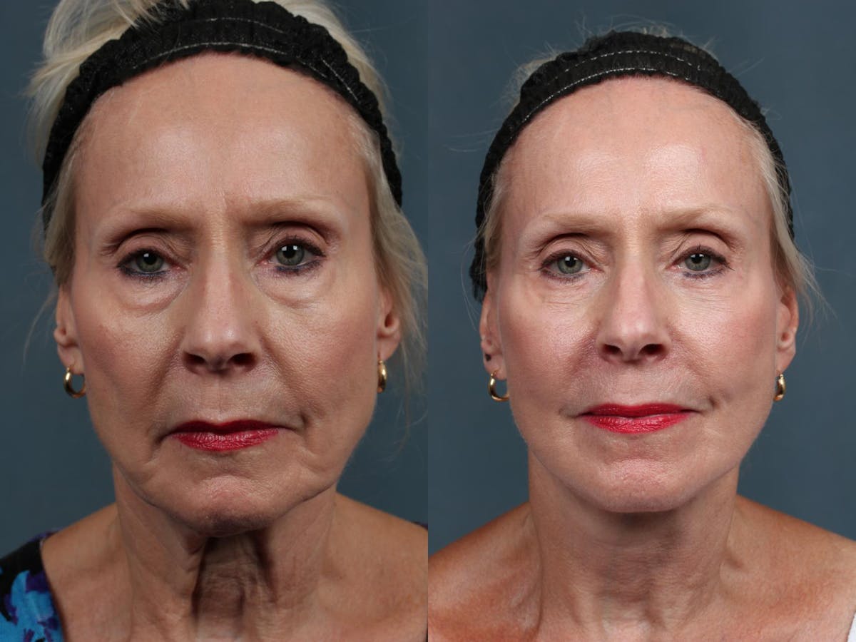 Facelift Before & After Gallery - Patient 334260 - Image 1