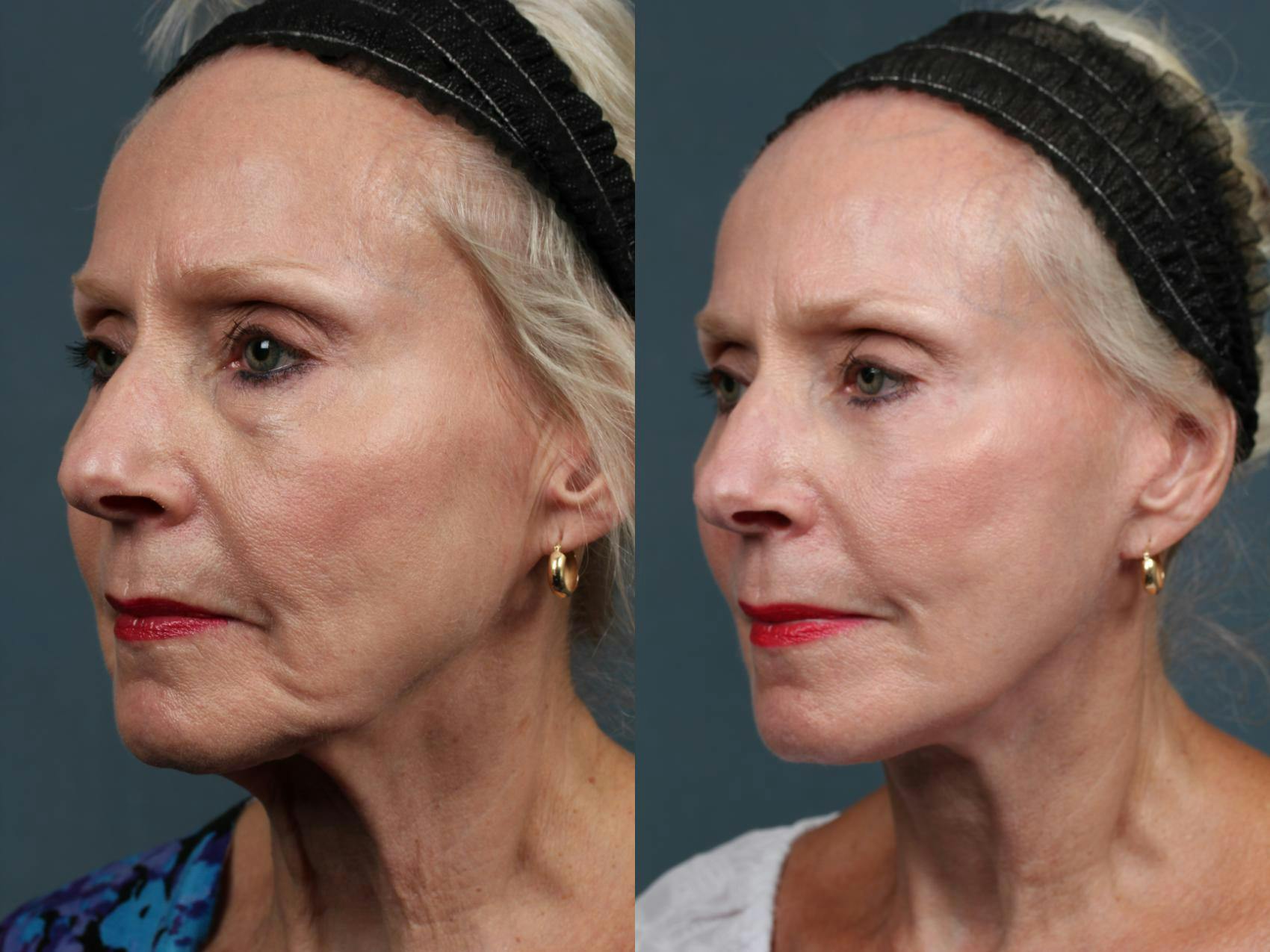 Facelift Before & After Gallery - Patient 334260 - Image 2