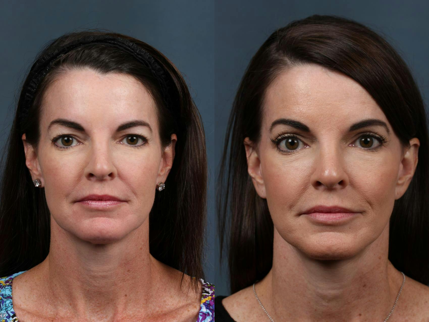 Facelift Before & After Gallery - Patient 322936 - Image 1