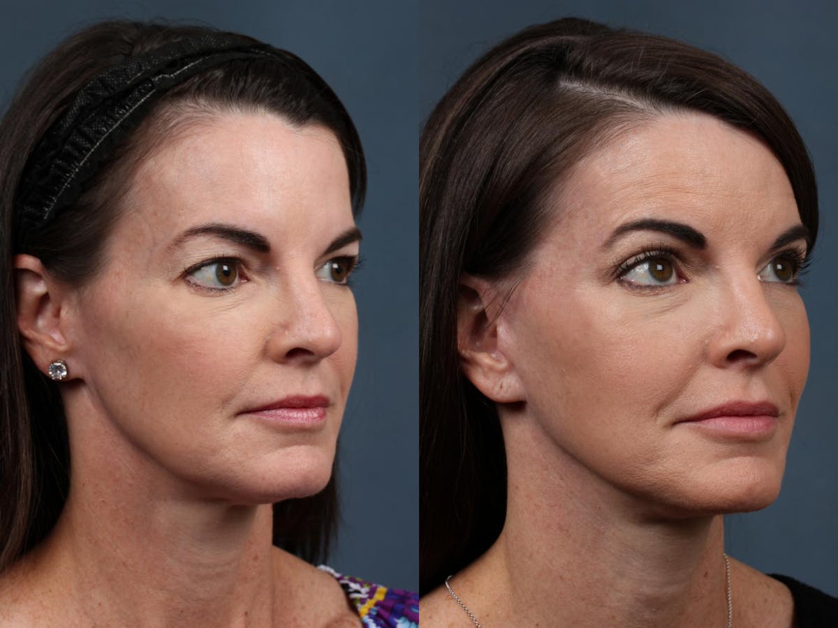 Facelift Before & After Gallery - Patient 322936 - Image 2
