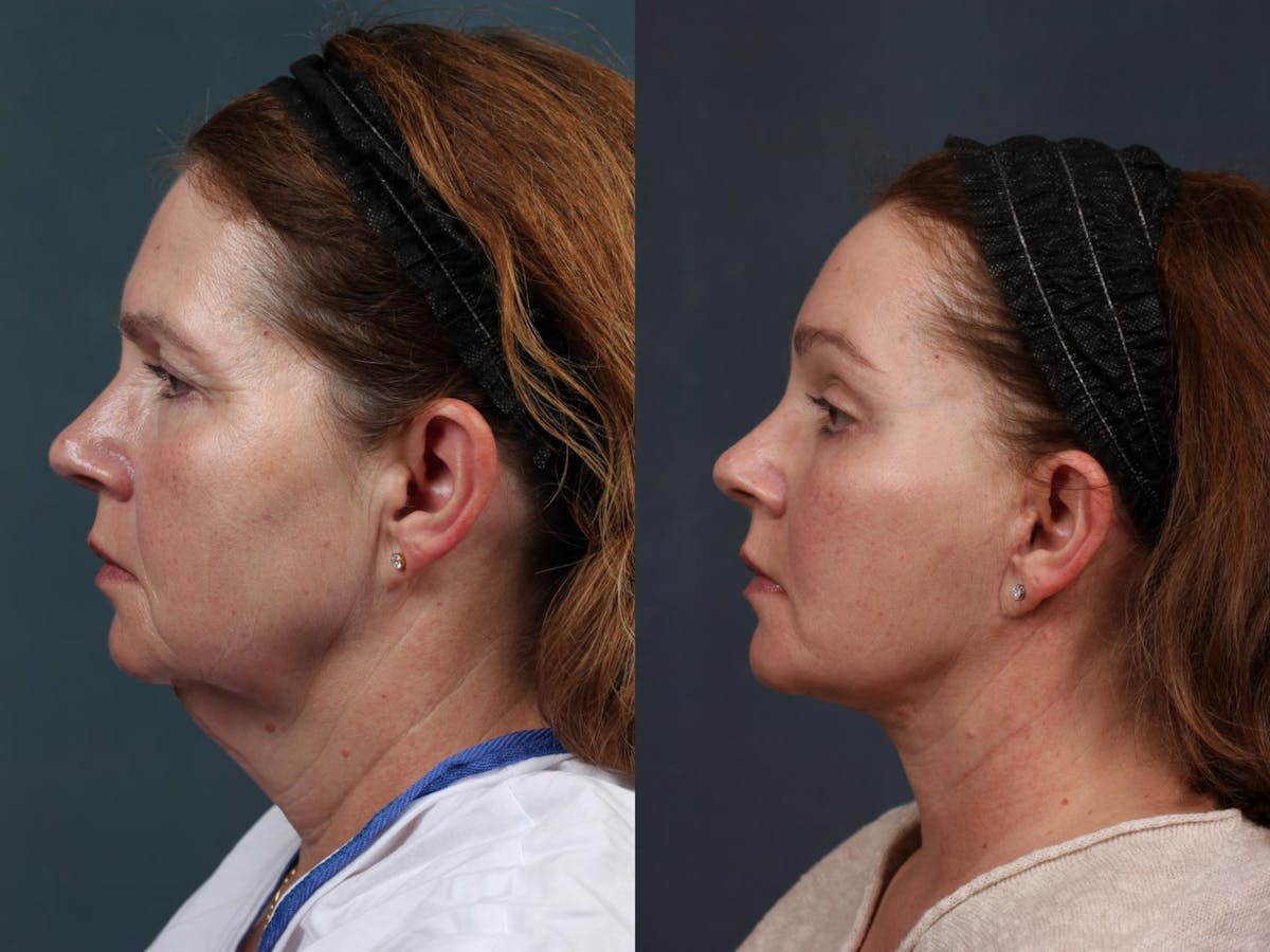 Facelift Before & After Gallery - Patient 126835 - Image 3