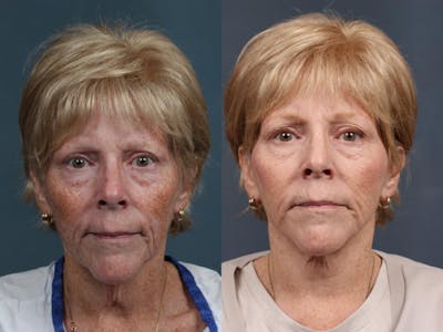 Facelift Before & After Gallery - Patient 213550 - Image 1