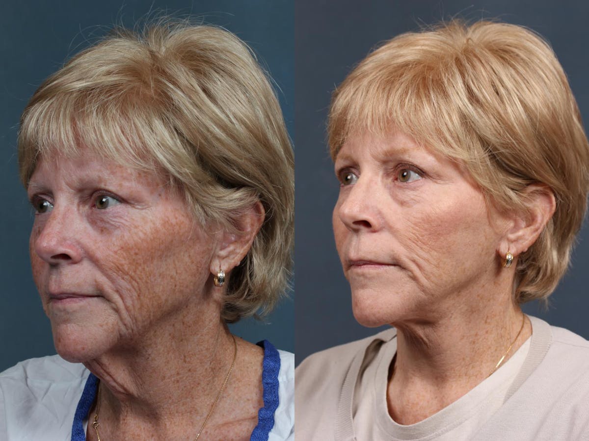 Facelift Before & After Gallery - Patient 213550 - Image 2