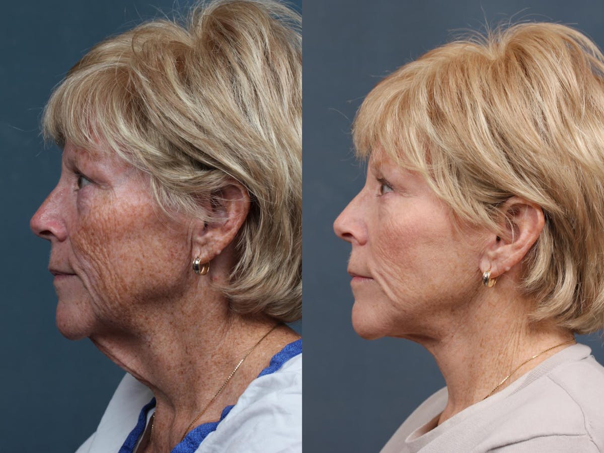 Facelift Before & After Gallery - Patient 213550 - Image 3