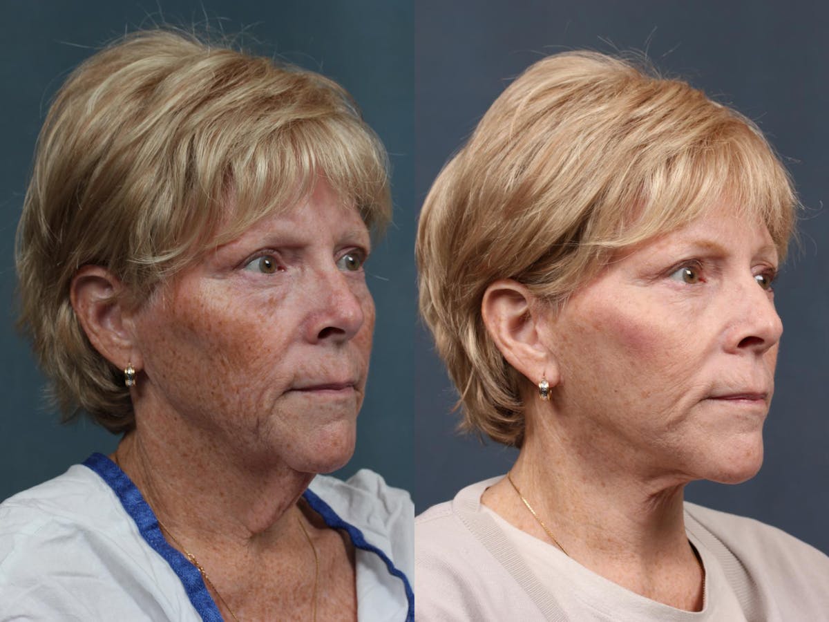 Facelift Before & After Gallery - Patient 213550 - Image 4