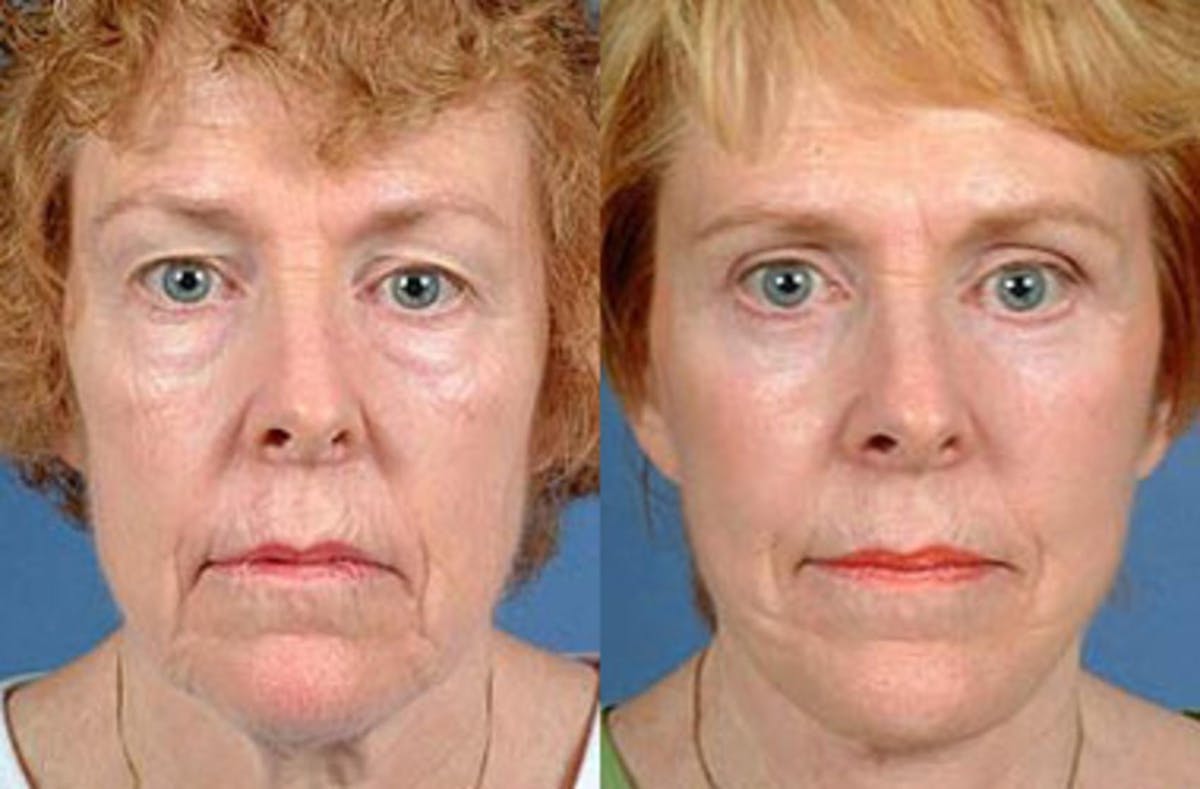 Facelift Before & After Gallery - Patient 351233 - Image 1