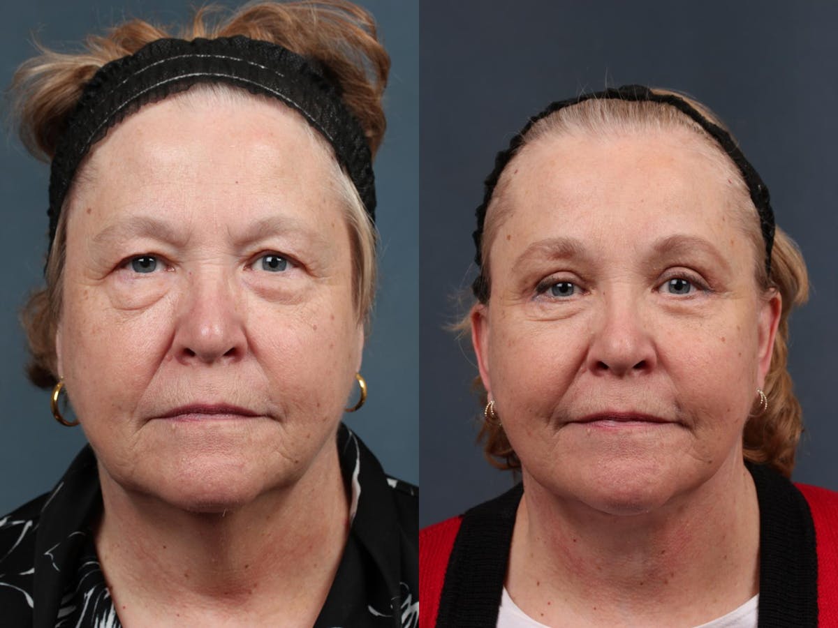 Facelift Before & After Gallery - Patient 169935 - Image 1